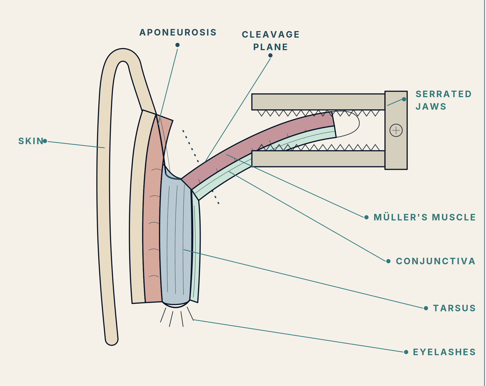 Coupe sagittale de la paupière supérieure éversée : les mors dentés de la pince se referment sur le pli de conjonctive et de muscle de Müller soulevé au-dessus du bord tarsal supérieur, le long du plan de clivage. Le tarse, l’aponévrose du releveur et la peau restent en dehors des mors.